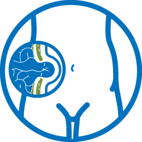 AS_Website Icons_Hernia surgery